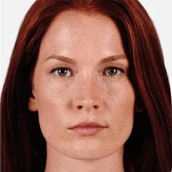 JUVÉDERM® VOLUMA® XC Before & After Patient #1652